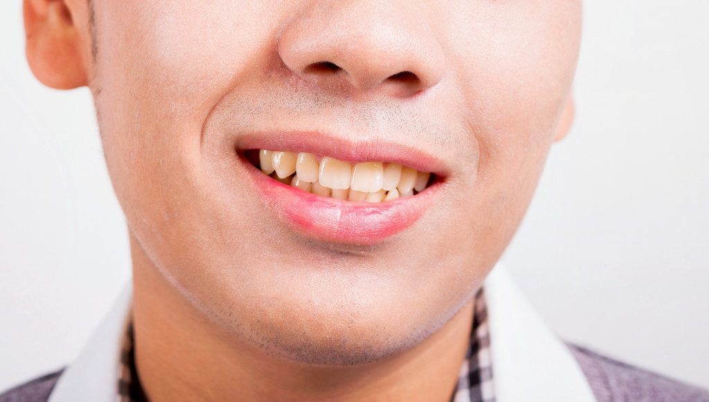 yellow teeth of a man shown while smiling