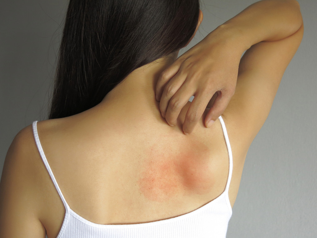 womans back with rashes and redness