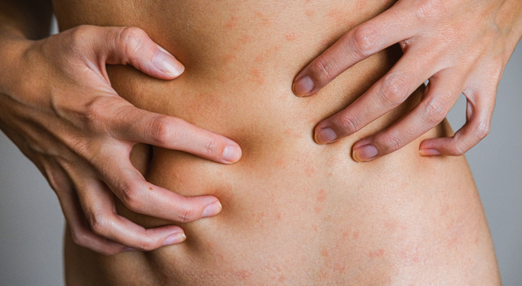 rashes on woman's skin concept of skin allergy