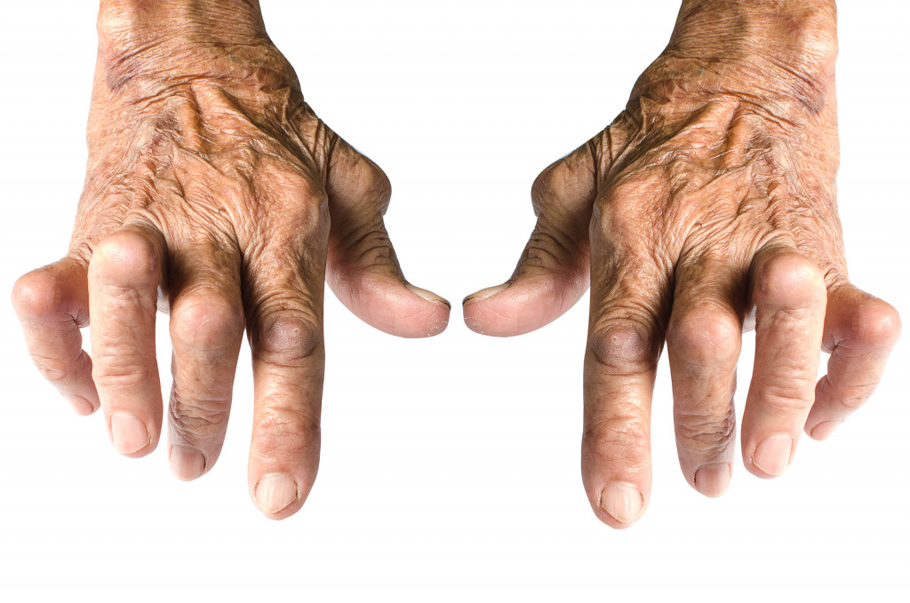Arthritis on hands
